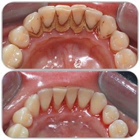 Detartraj si periaj profesional realizate in cabinetul Raddent
