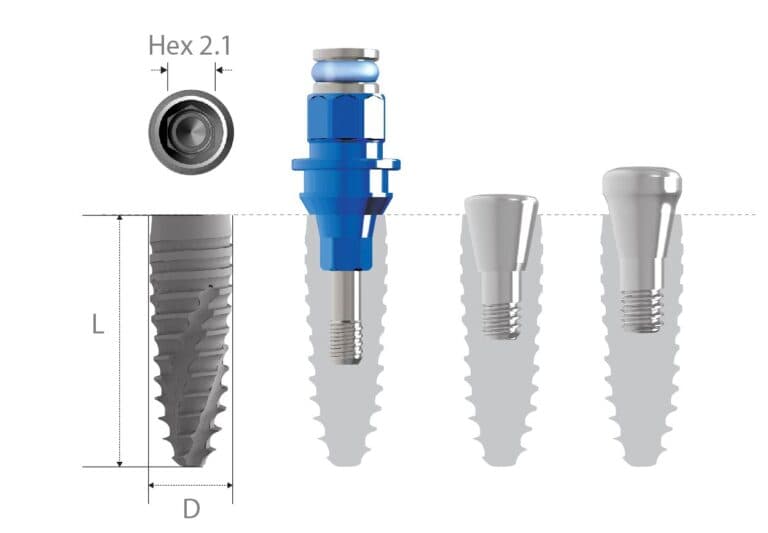 Implant dentar si restaurare fixa prezentate la cabinetul Raddent din Suceava