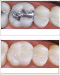 Obturatie dentara si refacere coronara prezentate de cabinetul Raddent