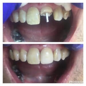 Reconstructie dentara cu pivot din fibra de sticla