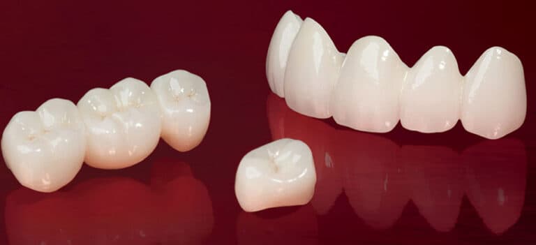 Lucrare dentara pe suport de zirconiu pentru estetica si rezistenta