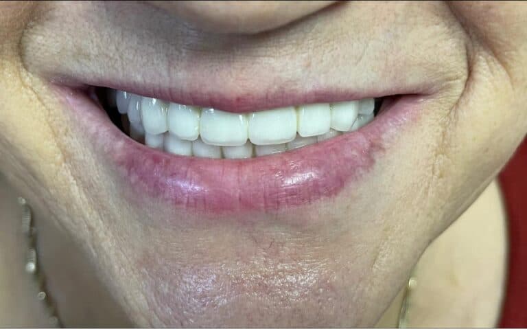 Lucrare cu zirconiu si ceramica presata pe implanturi pentru estetica dentara