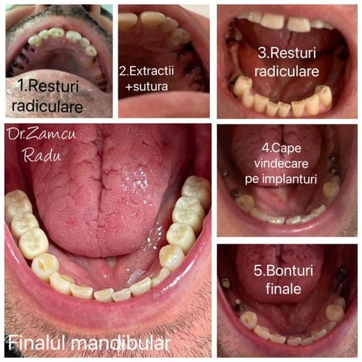 Lucrare cu zirconiu integral pe implanturi prezentata de Raddent