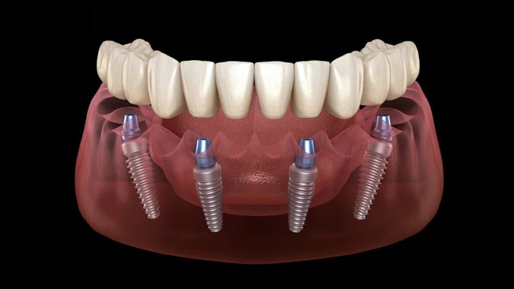 Lucrare dentara de tip All on 4 prezentata de cabinetul Raddent