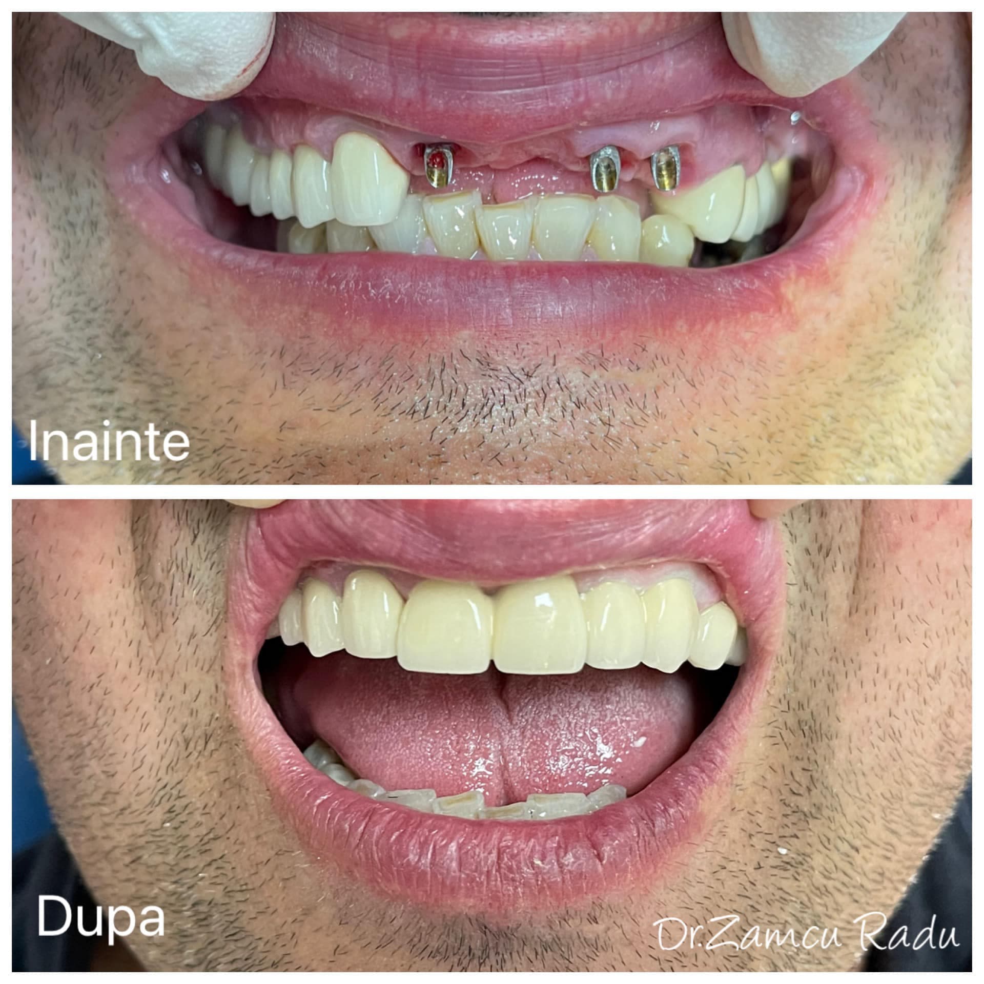 Lucrare metalo-ceramica pe implanturi realizata in context protetic la Raddent