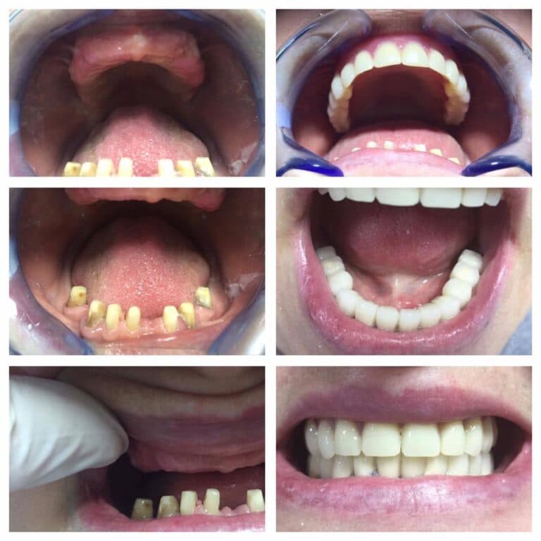 Proteza dentara pentru restaurarea arcadelor prezentata de cabinetul Raddent